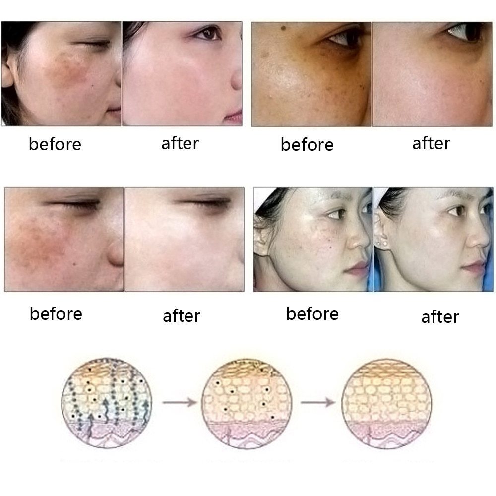 Transform Your Skin with Dredge Meridian Skin Care - Acne Stretch Marks Scar Removal Oil